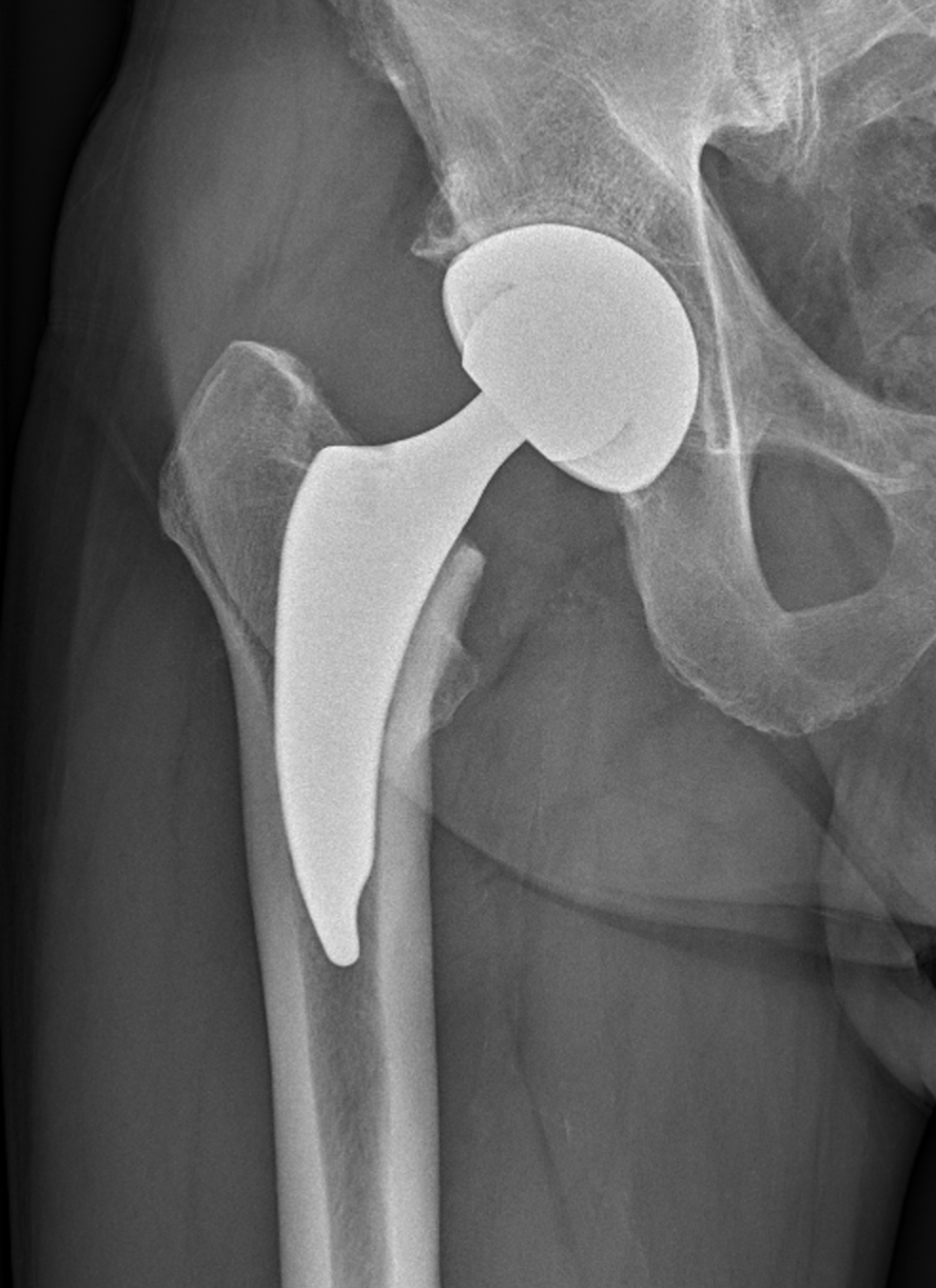 RTG snímek TEP kyčle