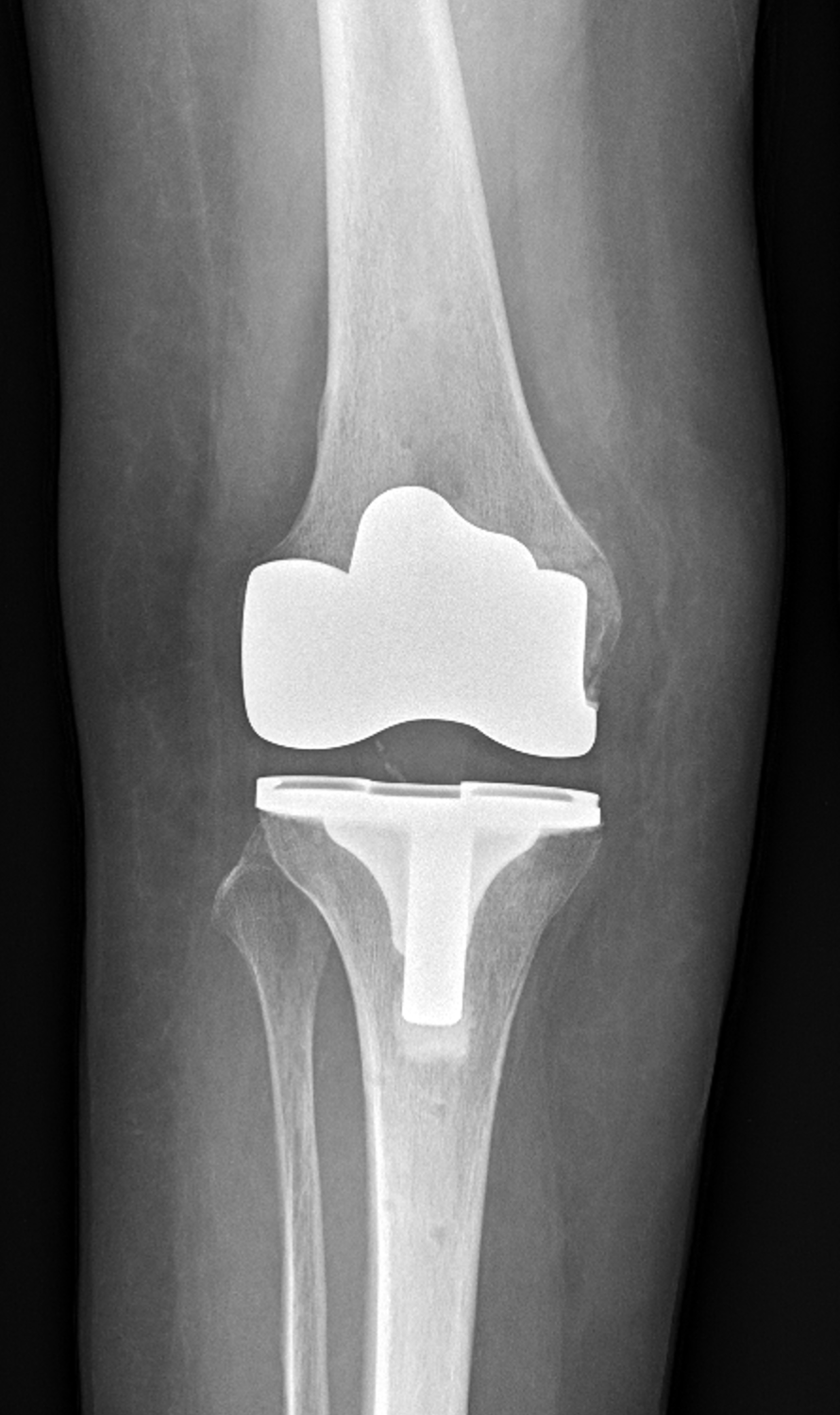 RTG snímek TEP kolene